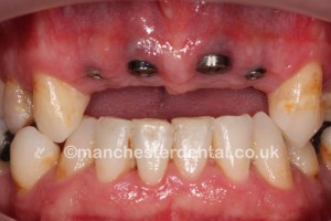 dental implants in